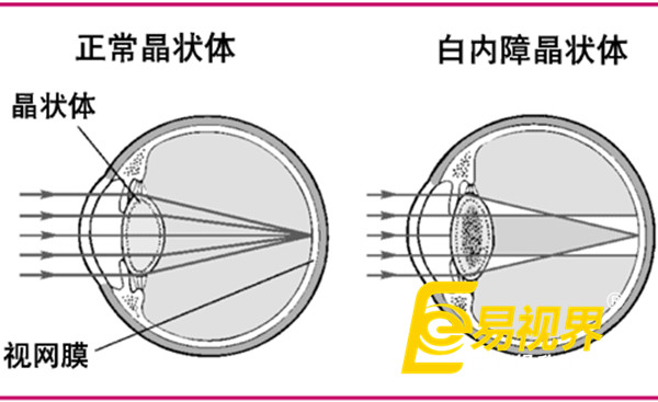  春節過(guò)量飲酒最傷眼  易視界