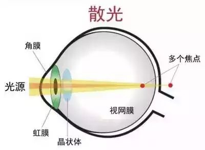易視界護眼專(zhuān)家為您講解什么是散光