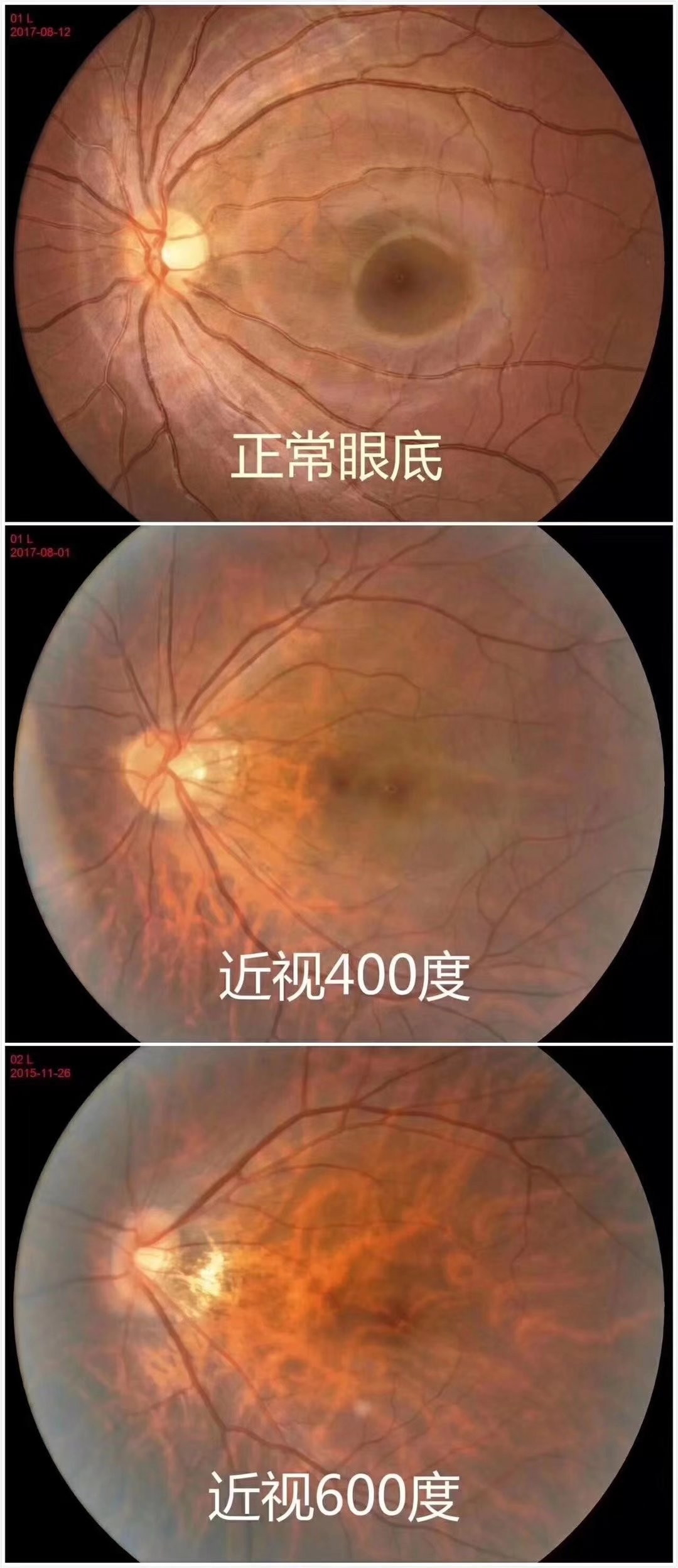 高度近視為什么會(huì )這么可怕_易視界