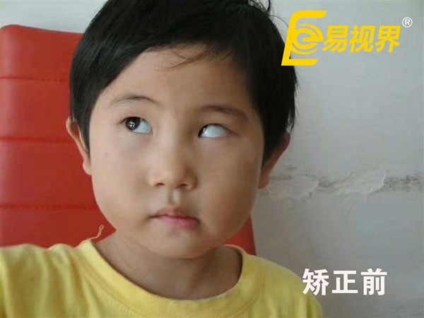易視界小客戶(hù)矯正前
