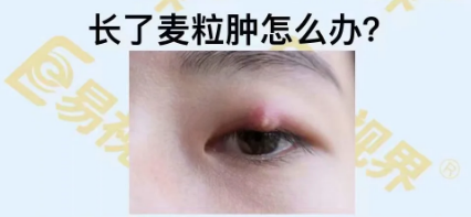 長(cháng)了麥粒腫怎么辦