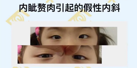 內眥贅肉引起的假性?xún)刃? width=