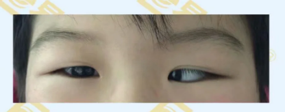 什么是先天性?xún)刃币暎? width=