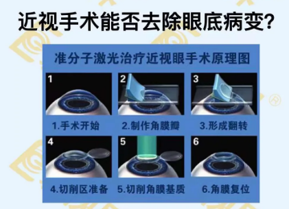 近視手術(shù)能否去除眼底病變？