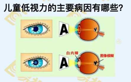 兒童低視力主要病因有哪些？