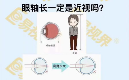 眼軸長(cháng)一定是近視嗎？