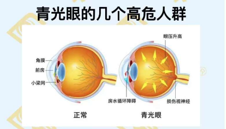 青光眼的幾個(gè)高危人群？