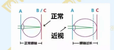 哪個(gè)年齡近視度數最容易增長(cháng)？