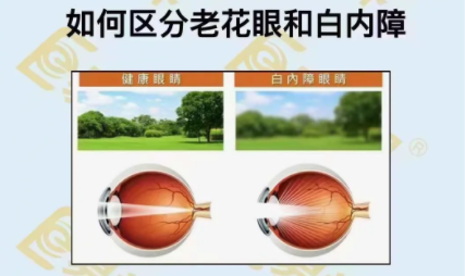 如何區分老花眼和白內障？
