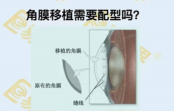角膜移植需要配型嗎？