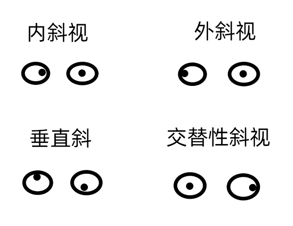 斜視早期的癥狀有哪些？